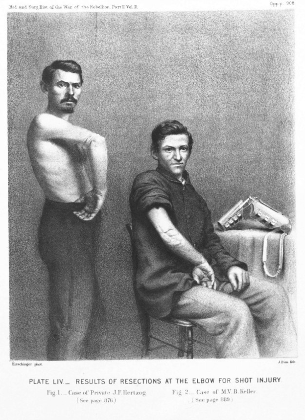 Schwarz-weiß-Zeichnung von zwei M├Ąnnern, einer sitzend in einem Stuhl mit einem Gegenstand, der andere stehend, mit Text unten lesend "plate liv - Ergebnisse von Resektionen am Ellenbogen für Schussverletzung".