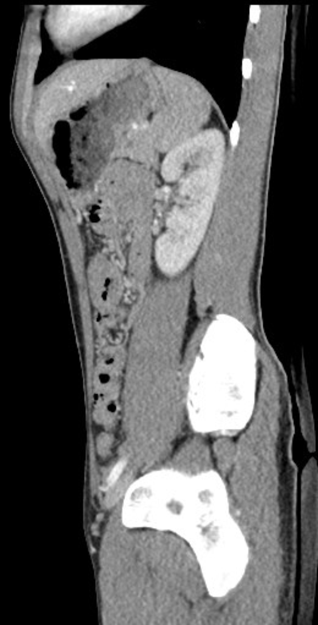 MRI-Aufnahme eines Knies, die einen Bruch in der Mitte zeigt, mit dunklem Hintergrund drumherum.